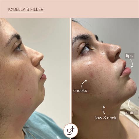 kybella liverpool|Kybella .